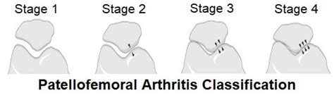 Patellofemoral Osteoarthritis