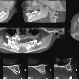 Panoramic radiograph of the father of the affected patient with ...