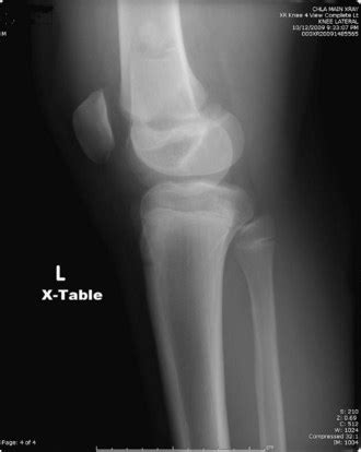 Physeal Fractures About the Knee | Musculoskeletal Key