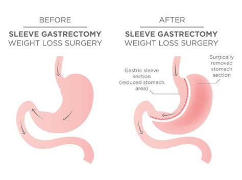 Gastric Sleeve Surgery - HealthStatus