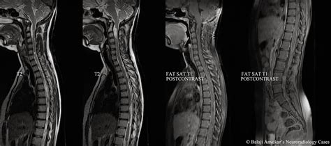 Lumbar Spine: Lumbar Spine With Contrast Mri