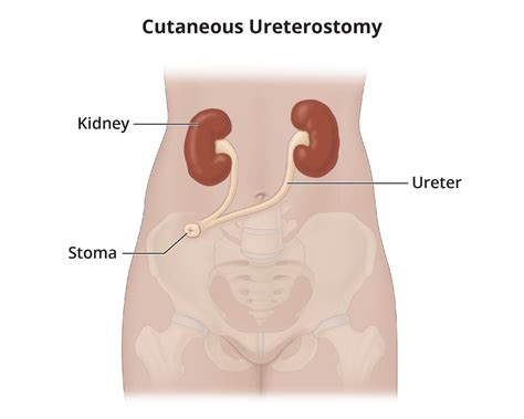 Urinary Diversion - NIDDK