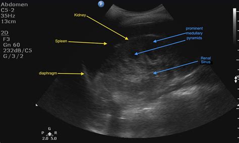 Hydronephrosis ~ Ultrasound Cases Info