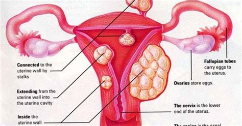 Fibroids | Nurselk.com