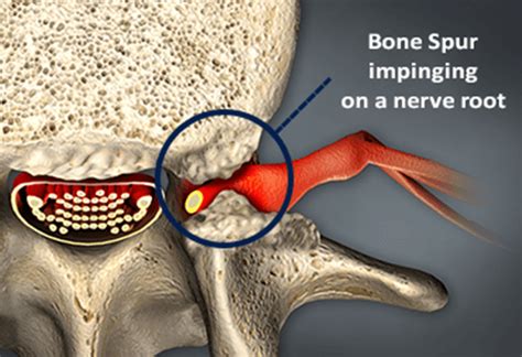 Bone Spurs - Osteophytes | Causes, Symptoms & Treatment