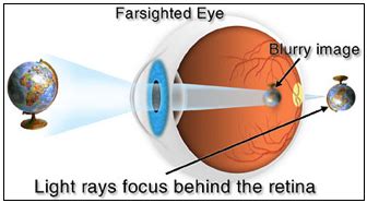 Hyperopia | Far Sightedness & Long Sightedness in Singapore