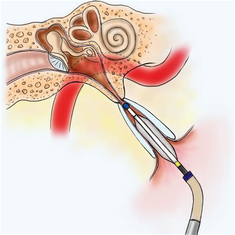 Eustachian Tube Balloon Dilation - Ear & Sinus Institute