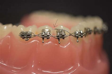 Orthodontics Australia | What to Do If Your Braces Are Broken