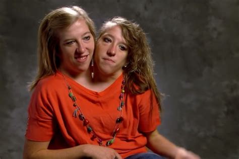 Years After These Siamese Twins Were Born, They Shared Shocking News ...