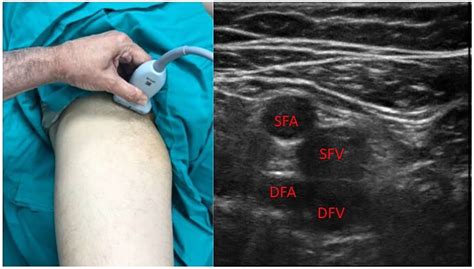 Rapid Femoral Vein Assessment (RaFeVA): A systematic protocol for ultrasound evaluation of the ...