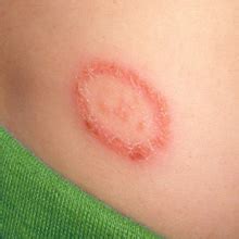 Ringworm in Armpit: Causes, Symptoms and Treatment of Armpit Fungus