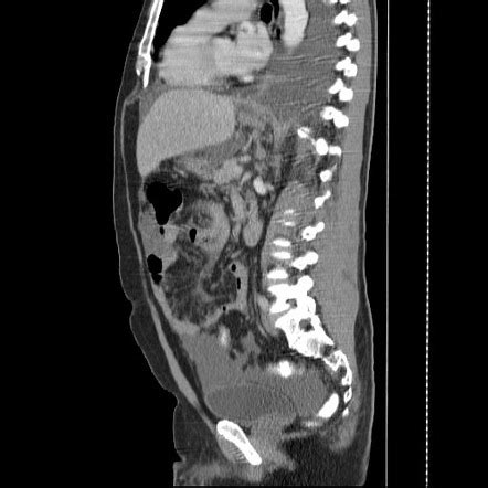 Omental cake | Image | Radiopaedia.org