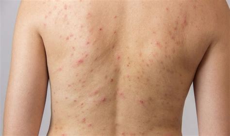 Acne mechanica caused by skin on skin friction | Dermatology Times and Multimedia Medical, LLC