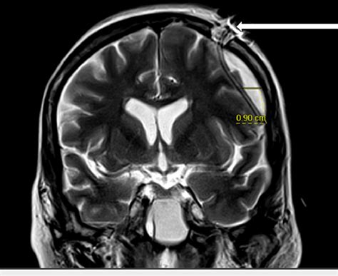 Magnetic resonance imaging status post burr hole procedure with ...