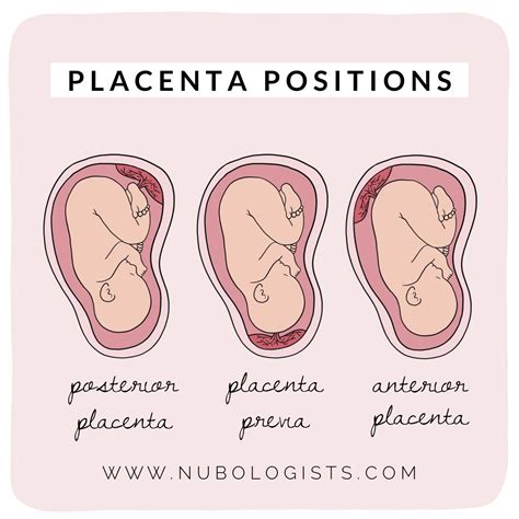 Comprehensive guide to placenta location and placenta previa types what ...