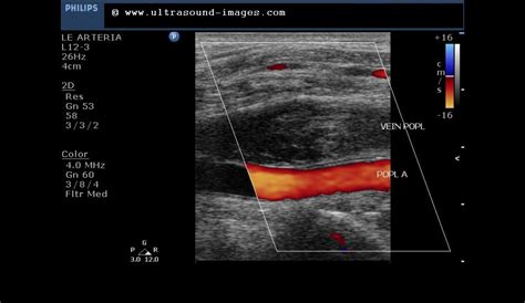 cochinblogs: Popliteal vein thrombosis- on arterial Doppler study