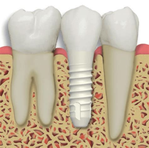 Dental Implant Center Los Angeles | LA Periodontists