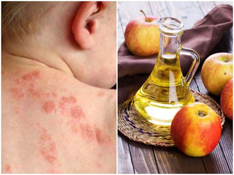 How to Treat Eczema with Apple Cider Vinegar - Best Herbal Health