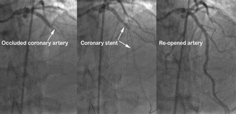 Angioplasty and Stent | Your Practical Exercise Guide 2023