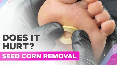 Corn On Foot How To Remove on Sale | emergencydentistry.com