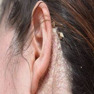 Eczema on Ear - How to Get Rid of Itchy or Dry Ear Eczema?