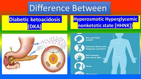 Diabetic ketoacidosis (DKA) Vs. Hyperosmotic Hyperglycemic nonketotic state ( HHNK ) - Diabetes