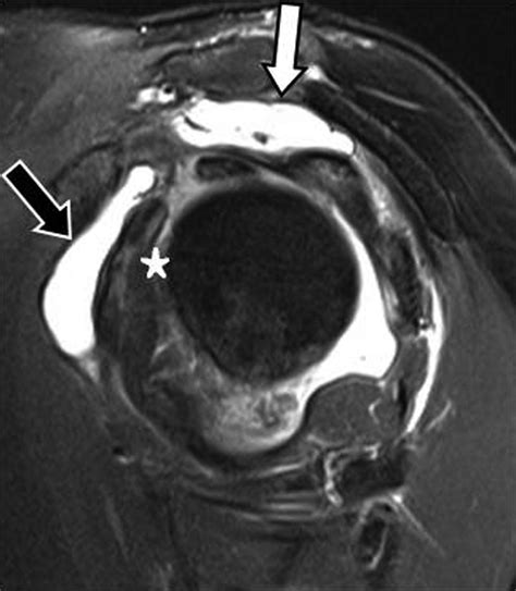 Subacromial Subdeltoid Bursitis Mri