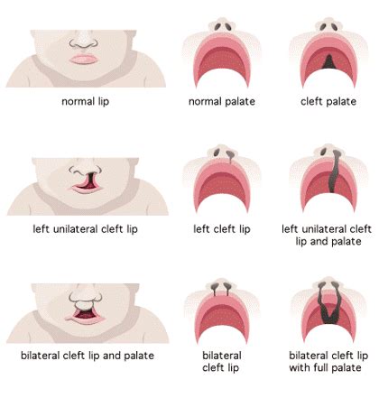 Everything About Cleft – Cleft Connect Australia