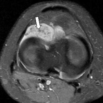 Pigmented Villonodular Synovitis Mri