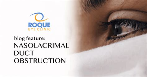 Nasolacrimal Duct Obstruction - NLDO - ROQUE Eye Clinic | Eye.com.ph