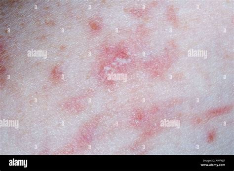 Eczema illustrating the Koebner Phenomenon Stock Photo - Alamy