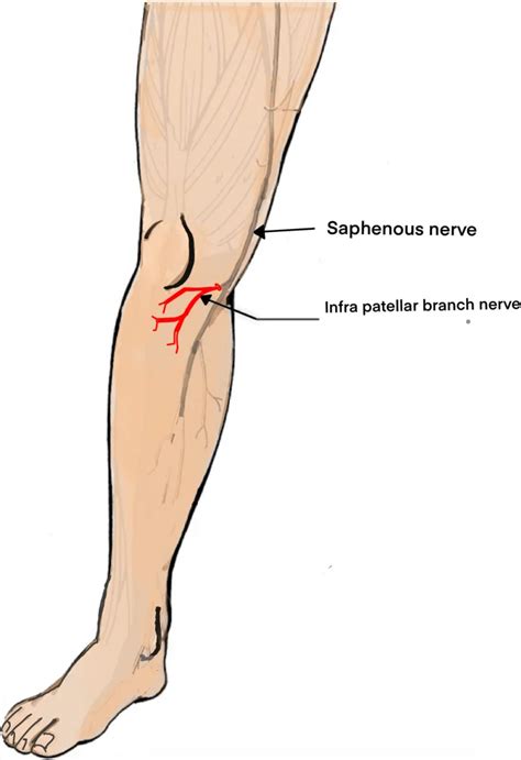 Saphenous Nerve Entrapment - Cause, Symptoms, Treatment