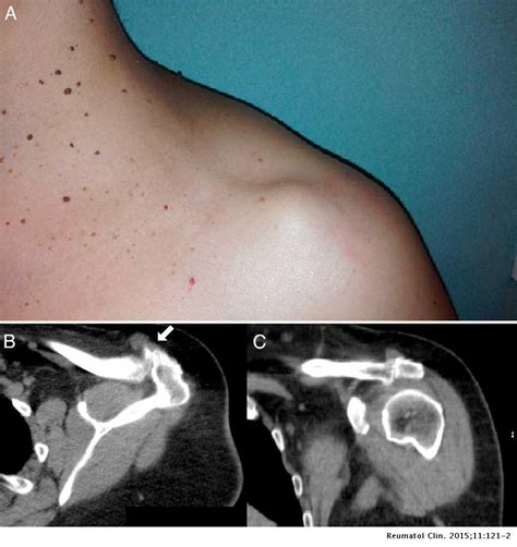 Quiste sinovial acromioclavicular con integridad del manguito rotador ...