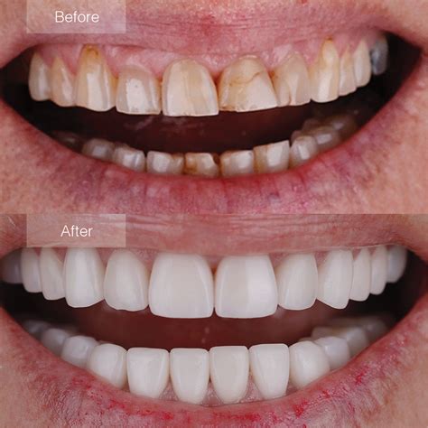 Porcelain Veneers Before and After - The Dental Room