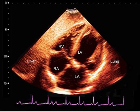 EKG Bilder Science Photo Library