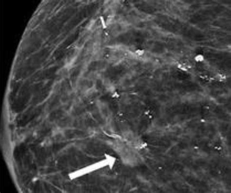 What a New Mammography Study Reveals About Surveillance Imaging in Women Treated for Ductal ...