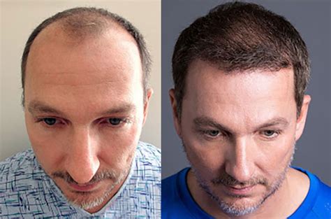 Hair Transplant Before/After Results for Men - Bosley Hair Transplant