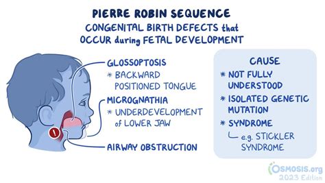 Rare Disease Education: Pierre-Robin Sequence | Sustainable Development Goals - Resource Centre