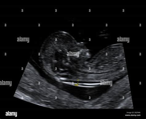 12 Week Ultrasound Pictures Down Syndrome