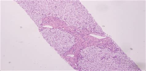 Liver histology in cholesteryl ester storage disease : Indian Journal ...
