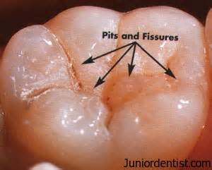 Pit and Fissure Sealents History | JuniorDentist.com