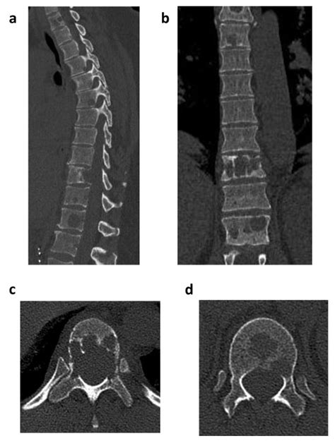 Computed tomography (CT) of the thoracic spine. Sagittal (a) and... | Download Scientific Diagram