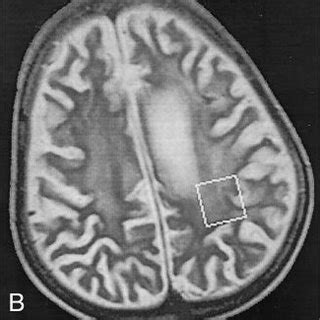 Findings in an 8-year-old boy with stage III SSPE. A, Coronal... | Download Scientific Diagram