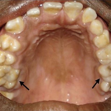 (PDF) Congenital hemifacial hyperplasia