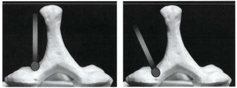 Cervical Decompression - TeachMe Orthopedics