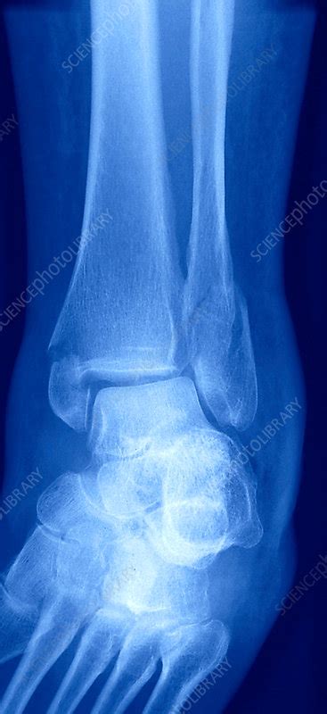 Bimalleolar ankle fractures, X-ray - Stock Image - C030/2144 - Science ...