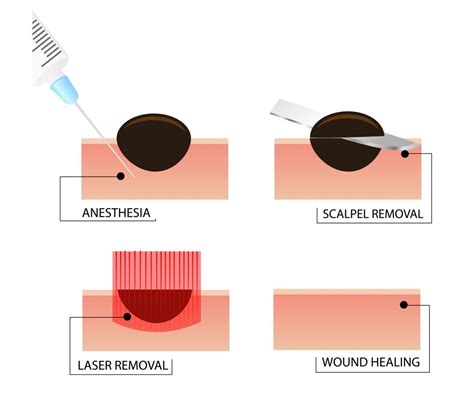 mole removal procedue 01 - The HealthUp