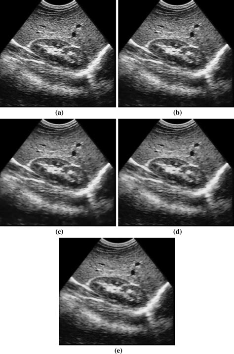 a Ultrasound image of liver cyst, despeckling with b AA model, c Dong ...