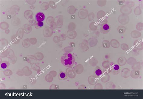 Blood Smear Anemia Patient Show Nrbc Stock Photo 637835905 | Shutterstock