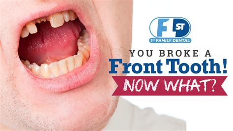 Broken Front Tooth! Now What? - 1st Family Dental Blog